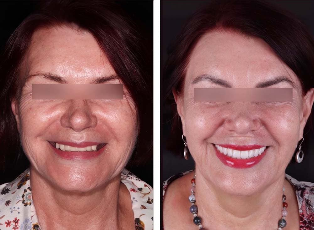 Clinical case study showing a full-mouth rehabilitation