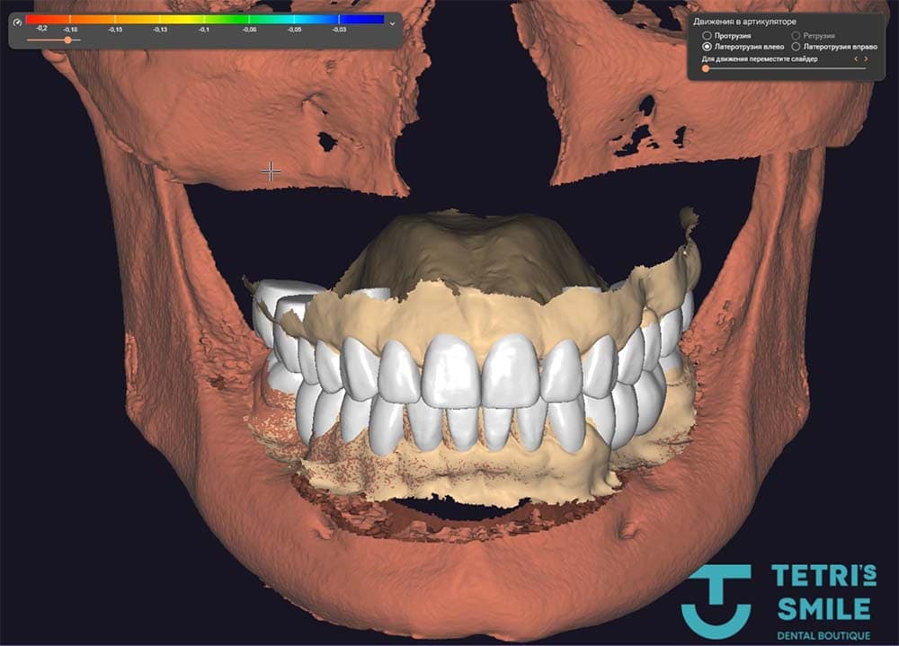 How to look after porcelain veneers — editorial image