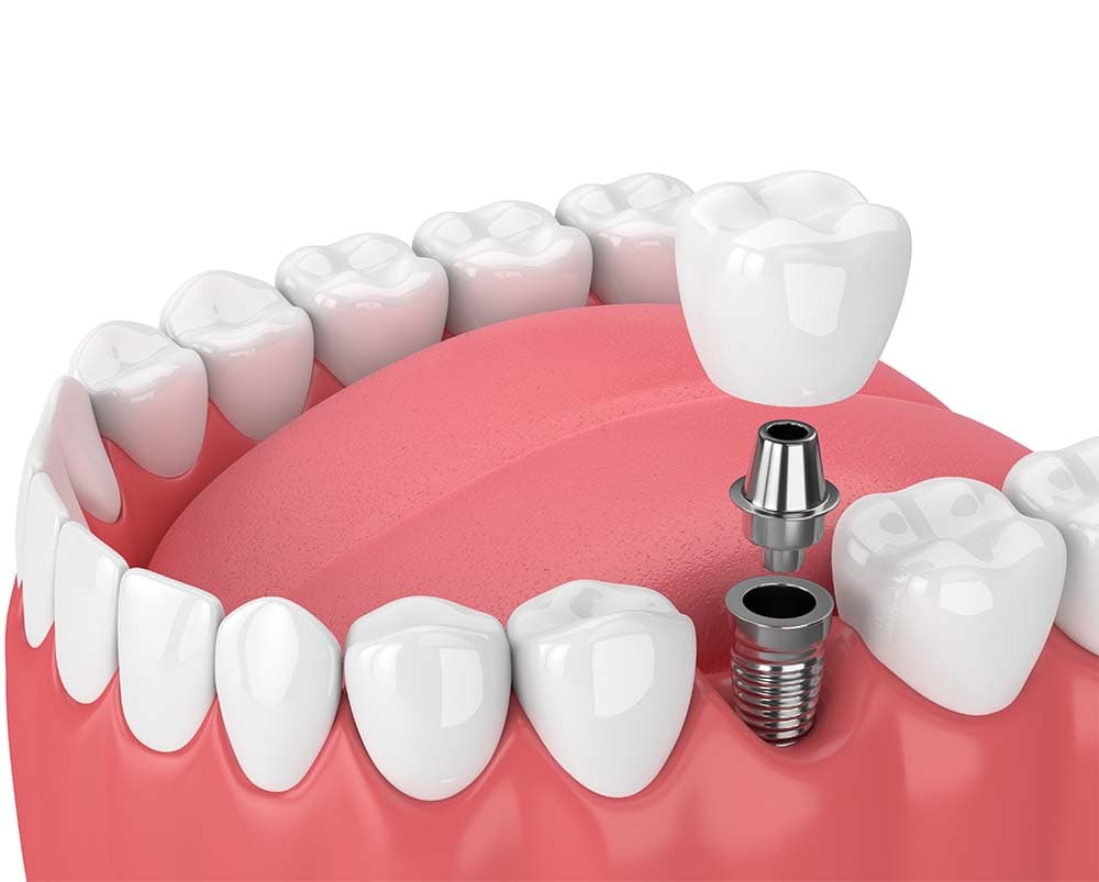 When an implant fails, rejection is usually the wrong word — editorial image
